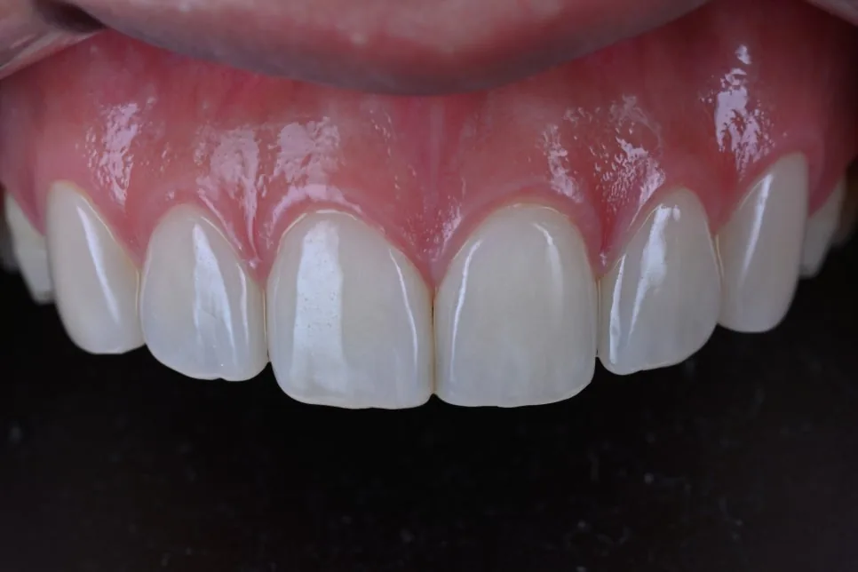 Close-up of natural-looking upper front teeth and gums against a dark background.