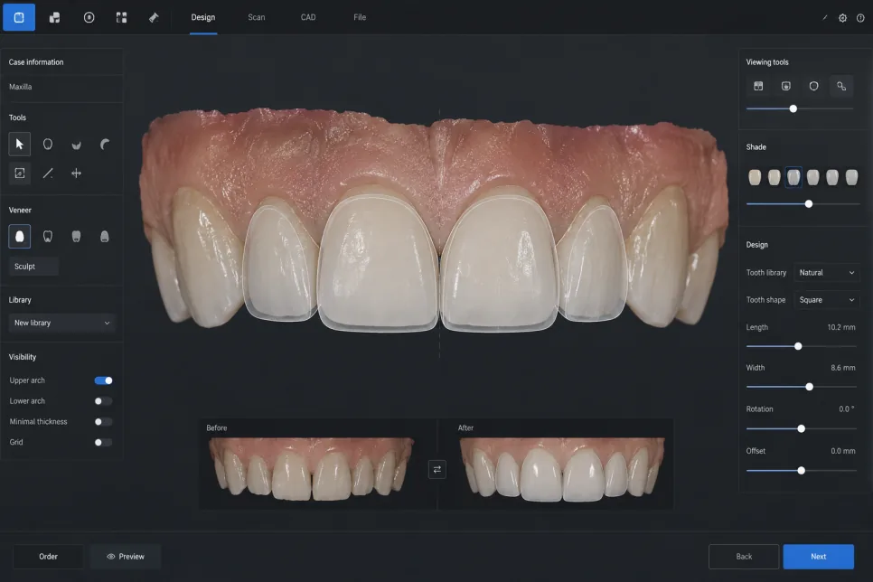 Digital smile design software showing veneer outlines over the upper front teeth, with before-and-after previews below.