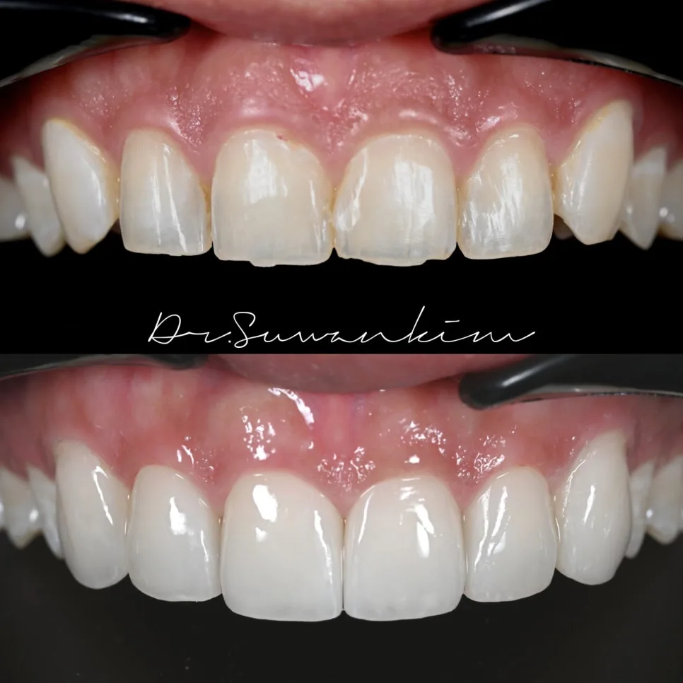 Before-and-after photos comparing uneven, discolored upper front teeth with evenly shaped, brighter teeth after veneers.
