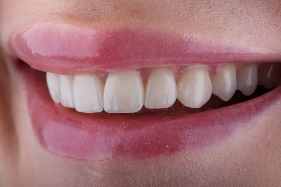 A close-up of a smile showing natural-looking upper front teeth.